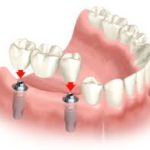  joseph wescott dds dental implants